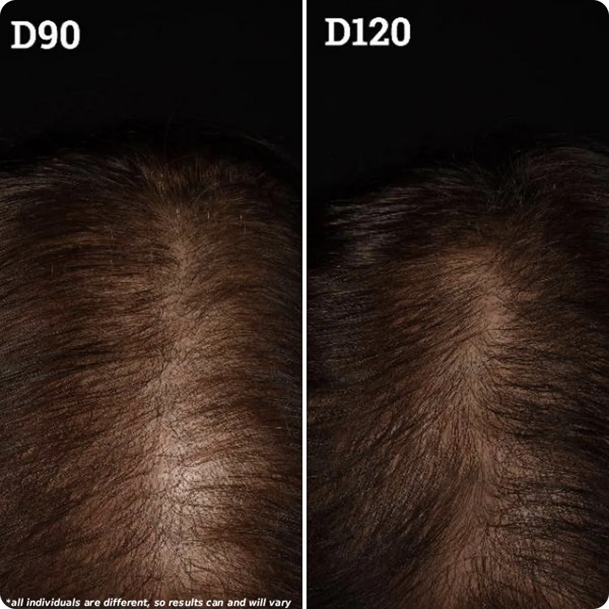 Capiluxe Pro™ | Sistema Avanzado Para Cabello Fino